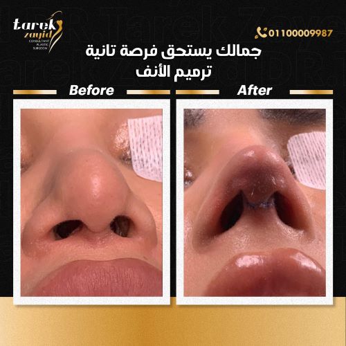 تجارب عمليات تجميل الأنف في مصر